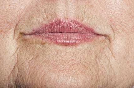 Everything You Ever Needed to Know About Lip Lines - Skin Perfection Natural and Organic Skin Care